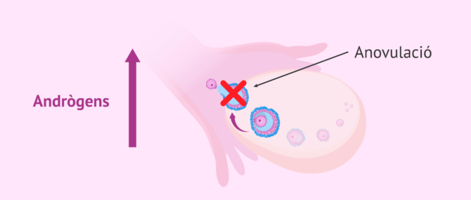 Imagen: Anovulació deguda al SOP