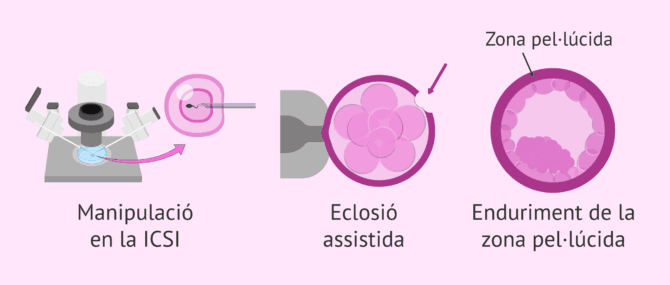 Imagen: Què influeix en la probabilitat de bessons en FIV?