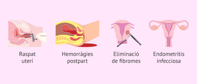 Imagen: Causes de les sinèquies uterines