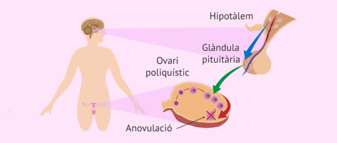 Imagen: Anovulació en dones amb SOP