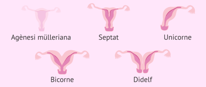 Imagen: Diferents malformacions uterines