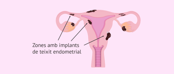 Imagen: Zones de l'aparell reproductor amb endometriosi