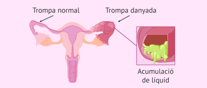 Imagen: Trompa normal i trompa afectada per hidrosàlpinx
