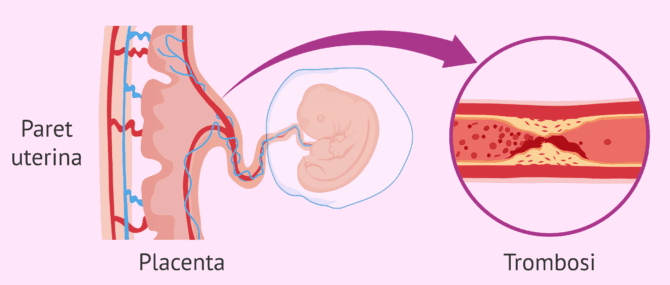 Imagen: Síndrome antifosfolipídica i avortaments