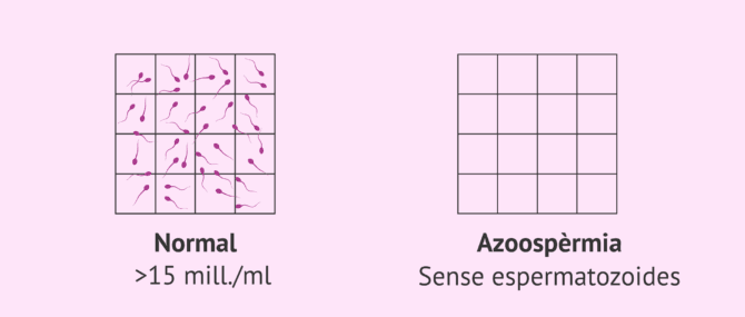 Imagen: Mostra de semen normal i mostra seminal amb azoospèrmia