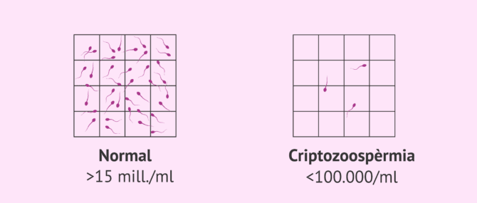 Imagen: Mostra seminal normal i mostra amb criptozoospèrmia