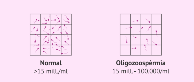 Imagen: Mostra seminal normal i mostra oligozoospèrmica