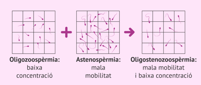 Imagen: Alteració seminal: oligoastenozoospèrmia