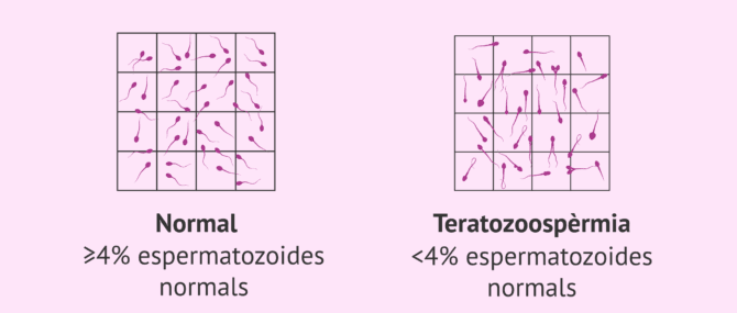 Imagen: Esterilitat masculina per teratozoospèrmia