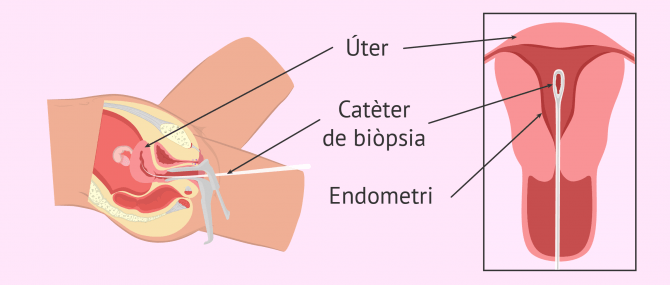 Imagen: Realització de biòpsia endometrial