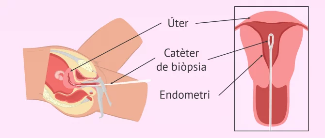 Imagen: Realització de biòpsia endometrial