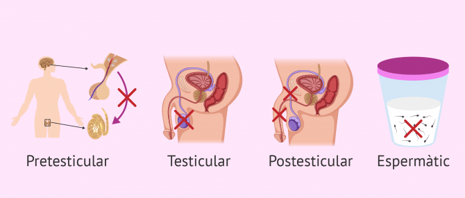 Imagen: Causes d'esterilitat masculina