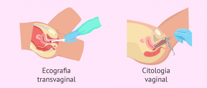 Imagen: Probes ginecològiques per a avaluar la fertilitat femenina