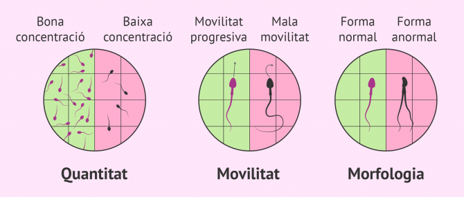 Imagen: Factor espermàtic d’esterilitat masculina