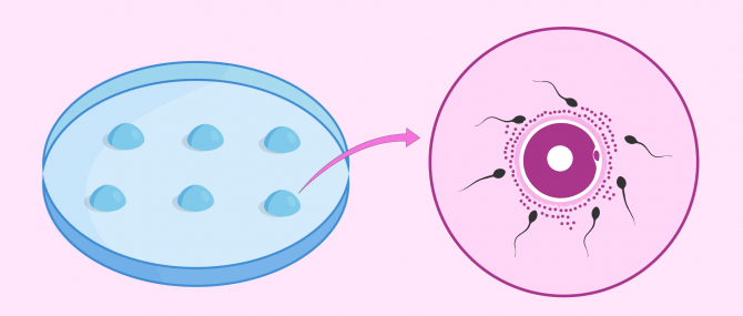 Imagen: Fecundación in vitro convencional