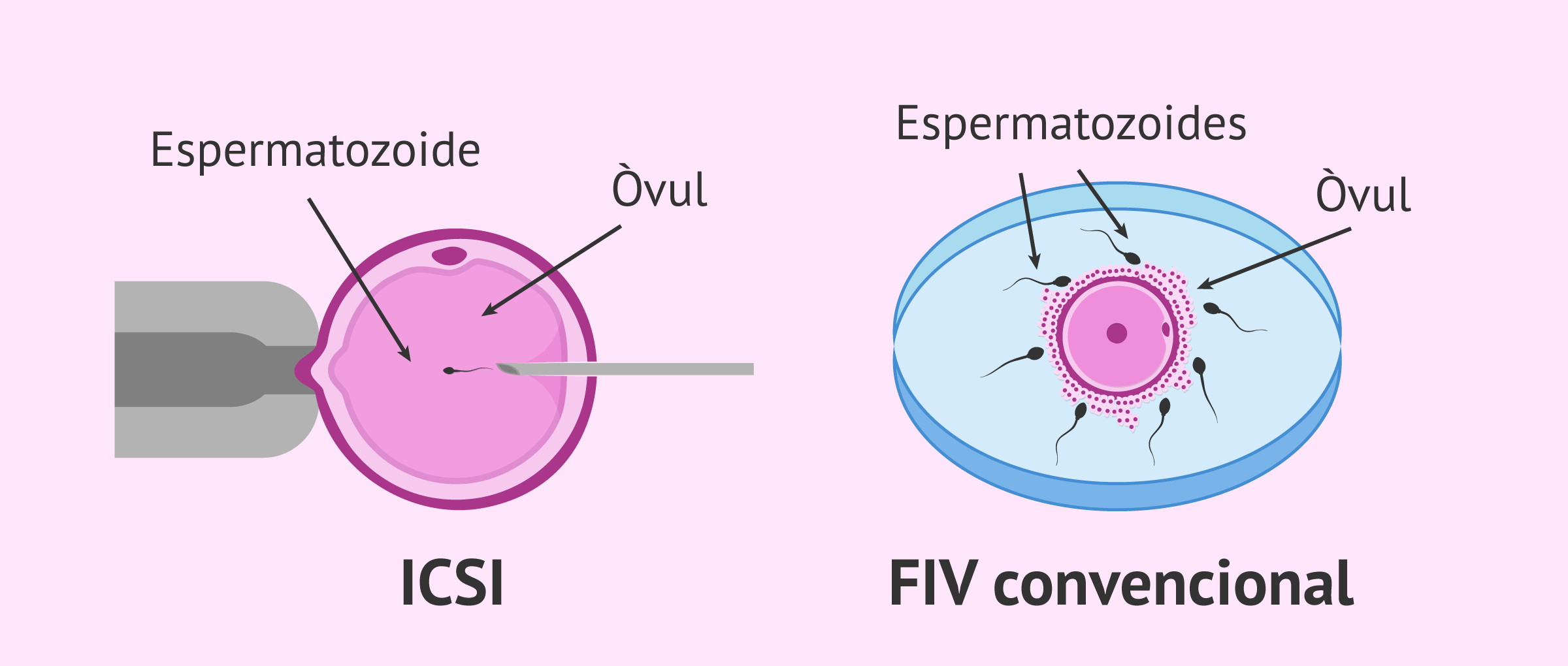 Comparació entre la FIV convencional i la ICSI
