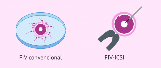 Imagen: Fecundació in vitro convencional o ICSI