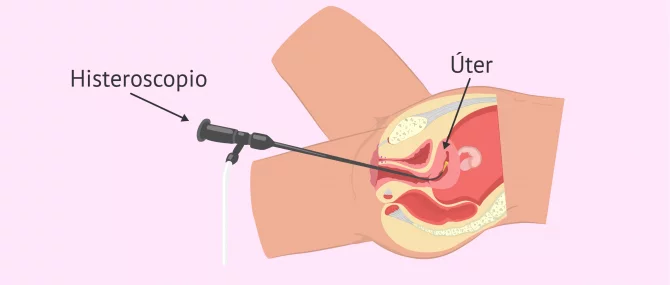 Imagen: Com es fa una histeroscòpia?