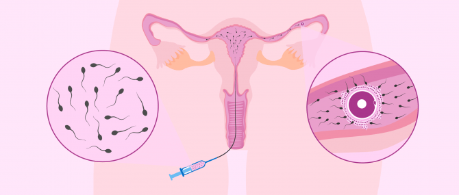 Imagen: La inseminació artificial intrauterina