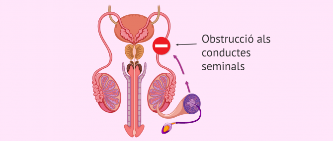 Imagen: Factor postesticular d’esterilitat masculina