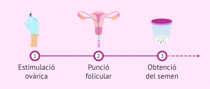 Imagen: Primers passos en un cicle de FIV