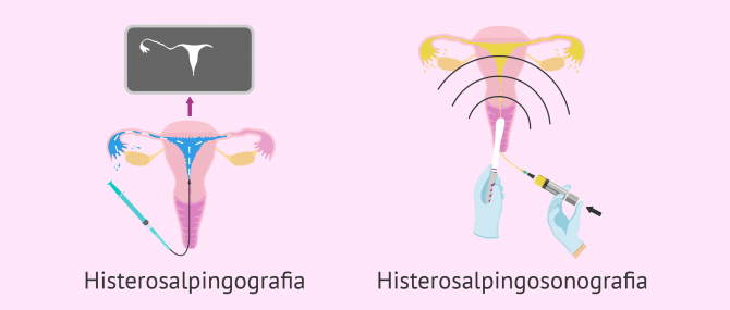 Imagen: Tipus de histerosalpingografia