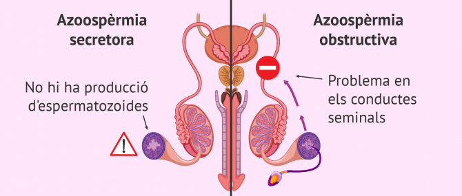 Imagen: Azoospèrmia secretora i obstructiva