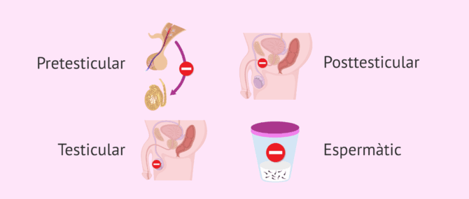 Imagen: Causes de la infertilitat en l'home
