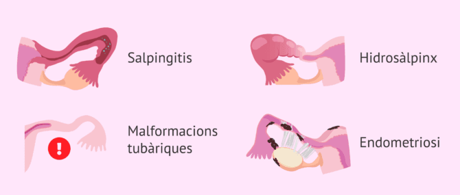 Imagen: Causes del factor tubàric en la dona