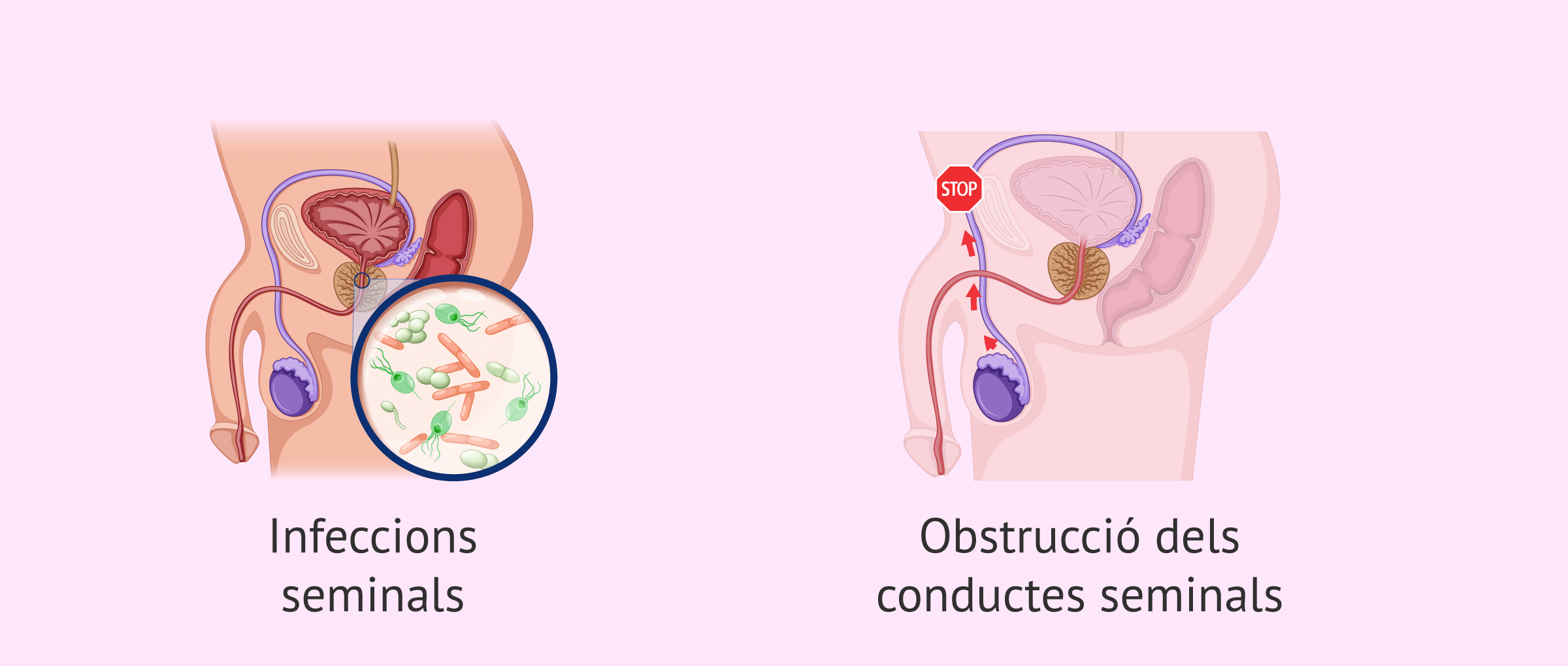 Oligospermia per causes posttesticulars