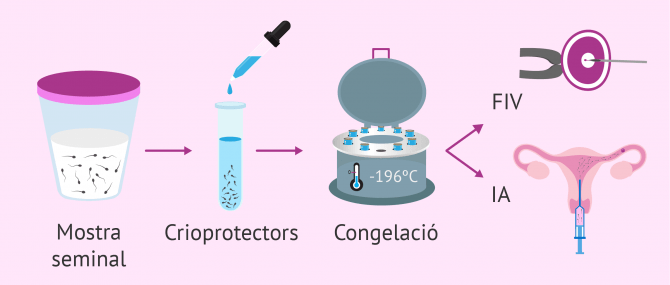 Imagen: Proceso de congelación de esperma