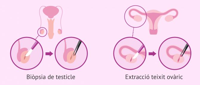 Imagen: Extracció de teixit ovàric i testicular per biòpsia
