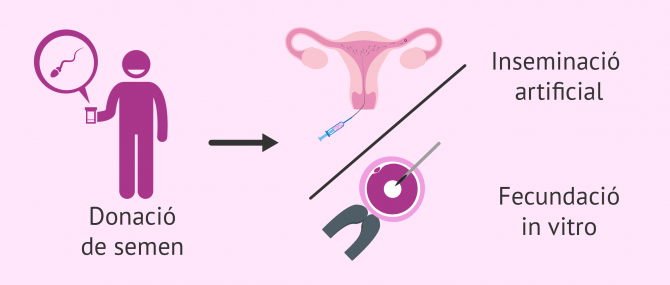 Imagen: Donació de semen per a inseminació artificial o per a FIV
