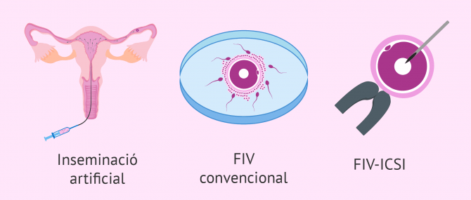 Imagen: Tècniques de reproducció assistida per a pacients amb oligospèrmia