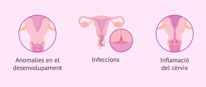 Imagen: Infertilitat femenina per factor cervical