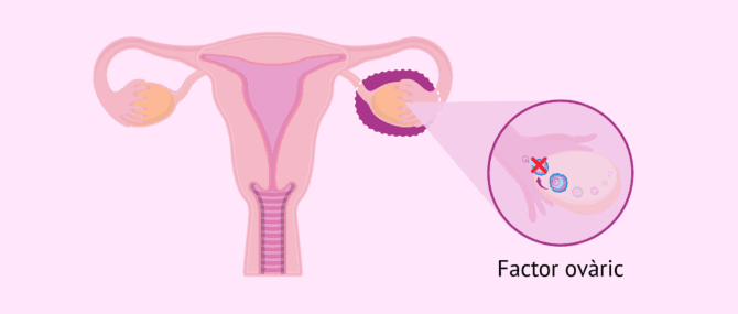 Imagen: Infertilitat femenina per factor ovàric