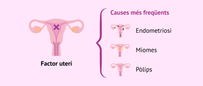 Imagen: Principals causes de la infertilitat femenina per factor uterí