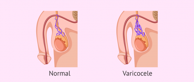 Imagen: Comparació de genitals amb varicocele