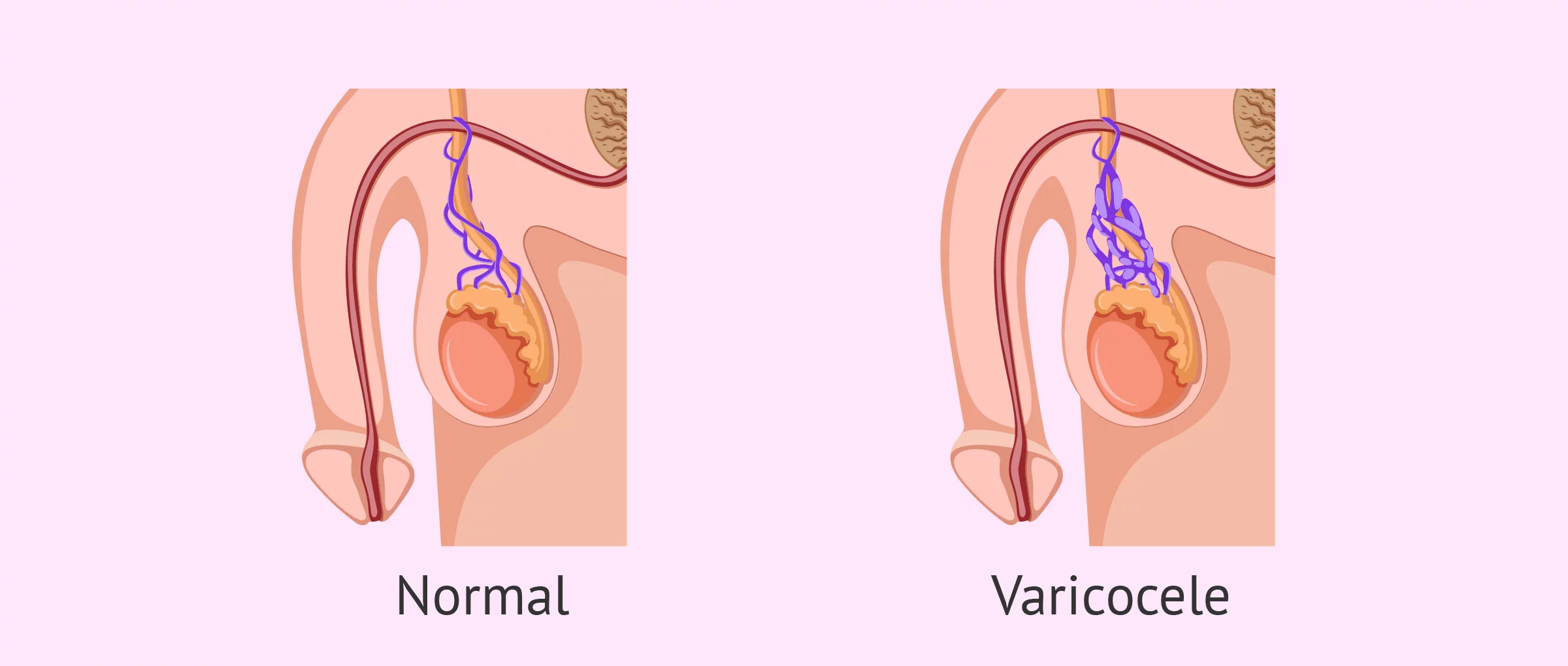 Comparació de genitals amb varicocele