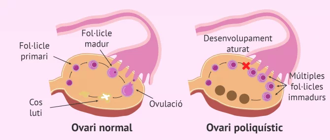 Imagen: Ovari normal vs. ovari poliquístic