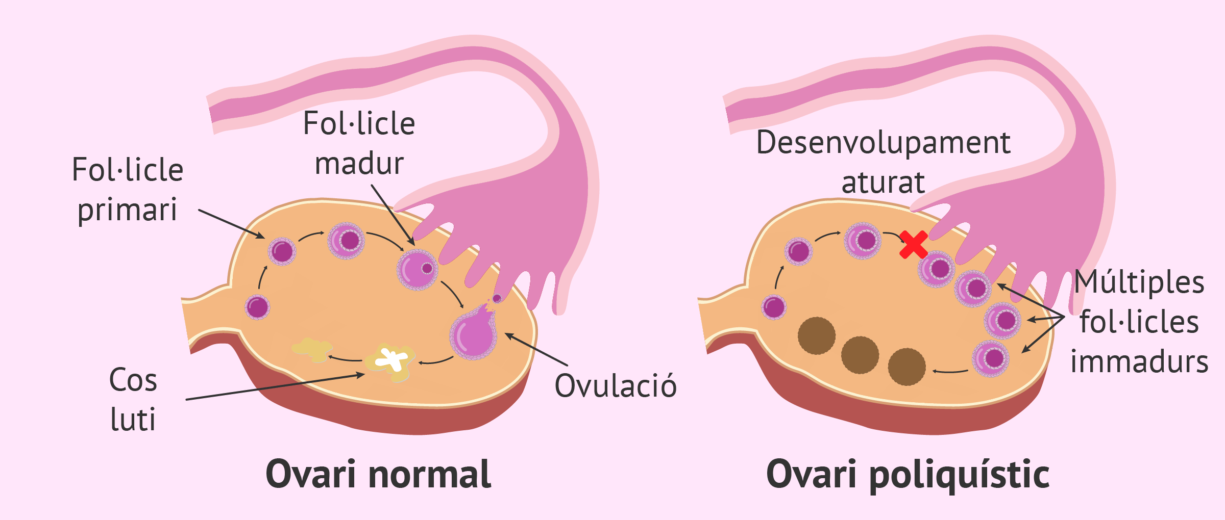 Ovari normal vs. ovari poliquístic