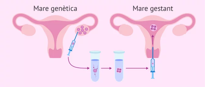 Imagen: Tenir un fill amb semen de donant per mètode ROPA