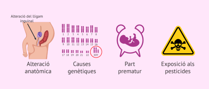 Imagen: Possibles causes de la criptorquídia