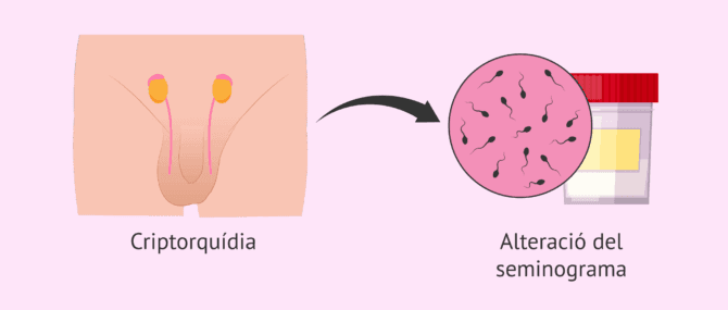 Imagen: Influeix la criptorquídia en la fertilitat masculina?