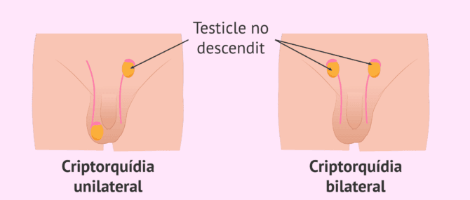 Imagen: Criptorquídia i fertilitat