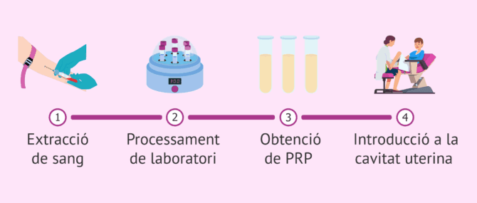 Imagen: Plasma ric en plaquetes per a millorar les possibilitats d'embaràs