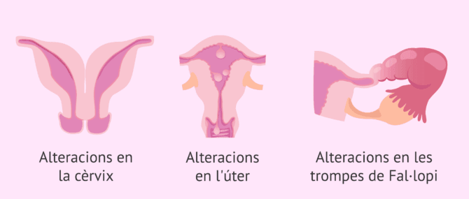 Imagen: Alteracions que detecta la HSG