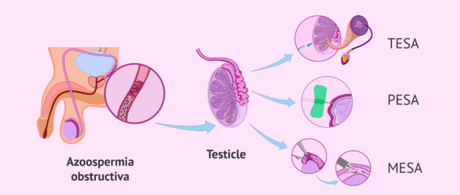 Imagen: Quins són els mètodes d'aspiració d'espermatozoides?
