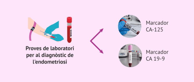 Imagen: Anàlisi de marcadors tumorals en el diagnòstic de l'endometriosi