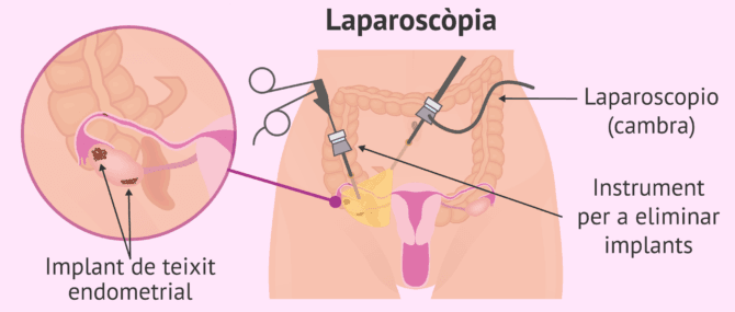 Imagen: Laparoscòpia per diagnosticar l'endometriosi